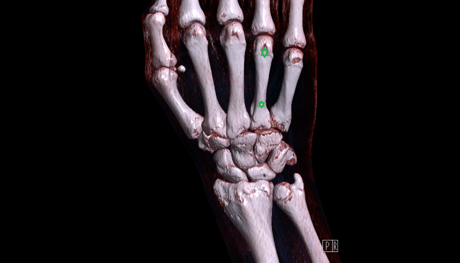 Metacarpal IV (4th)  bone bone CT 3D VRT image -img-00000-00000