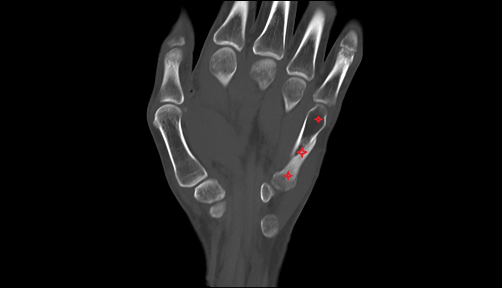 Metacarpal V (5th) ct coronal image