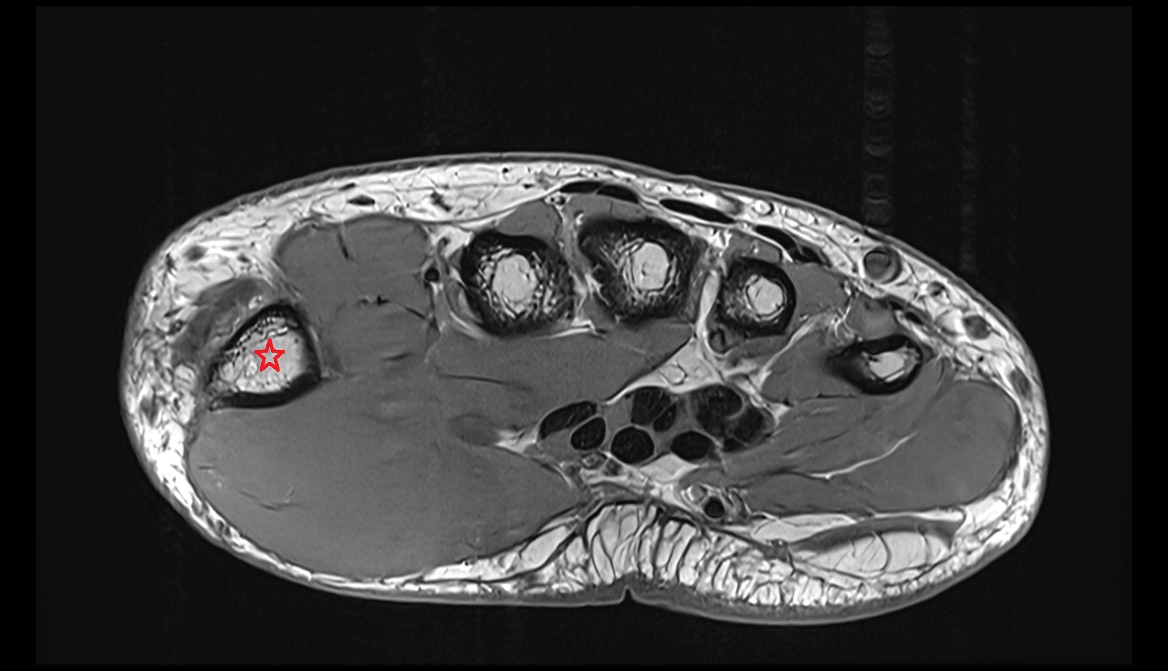 Metacarpal bone of thumb axial