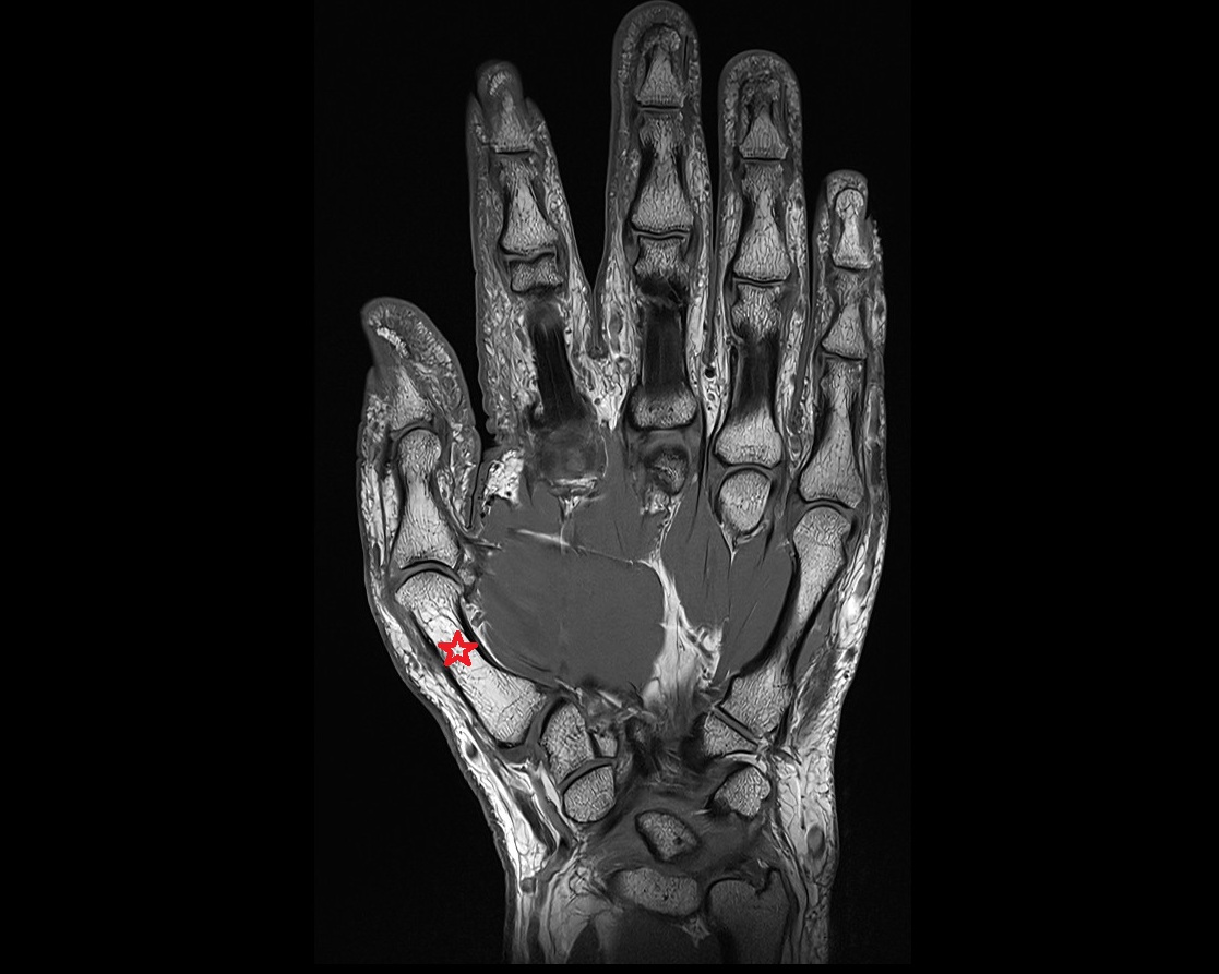 Metacarpal bone of thumb mri coronal
