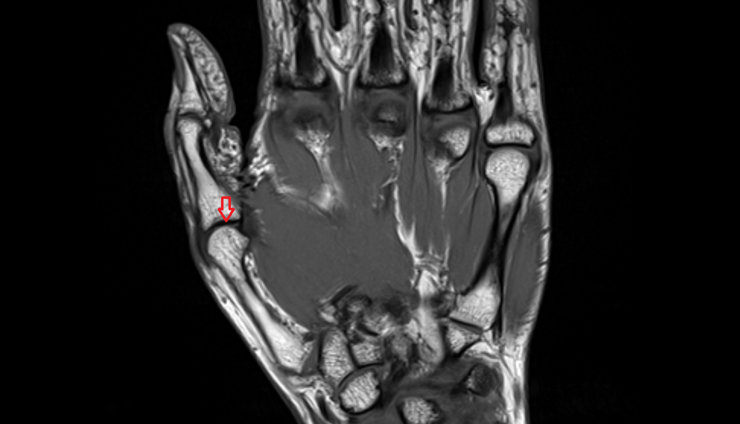 Metacarpophalangeal joint of thumb mri  anatomy labelled image-img-00000-00000