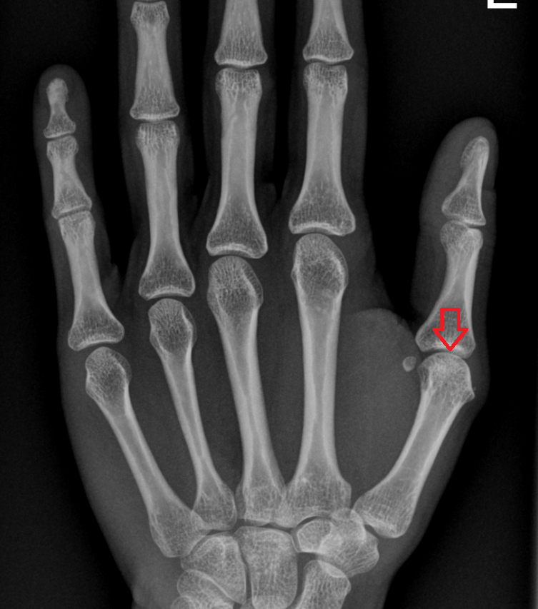 Metacarpophalangeal joint of thumb x ray  anatomy labelled image-img-00000-00000