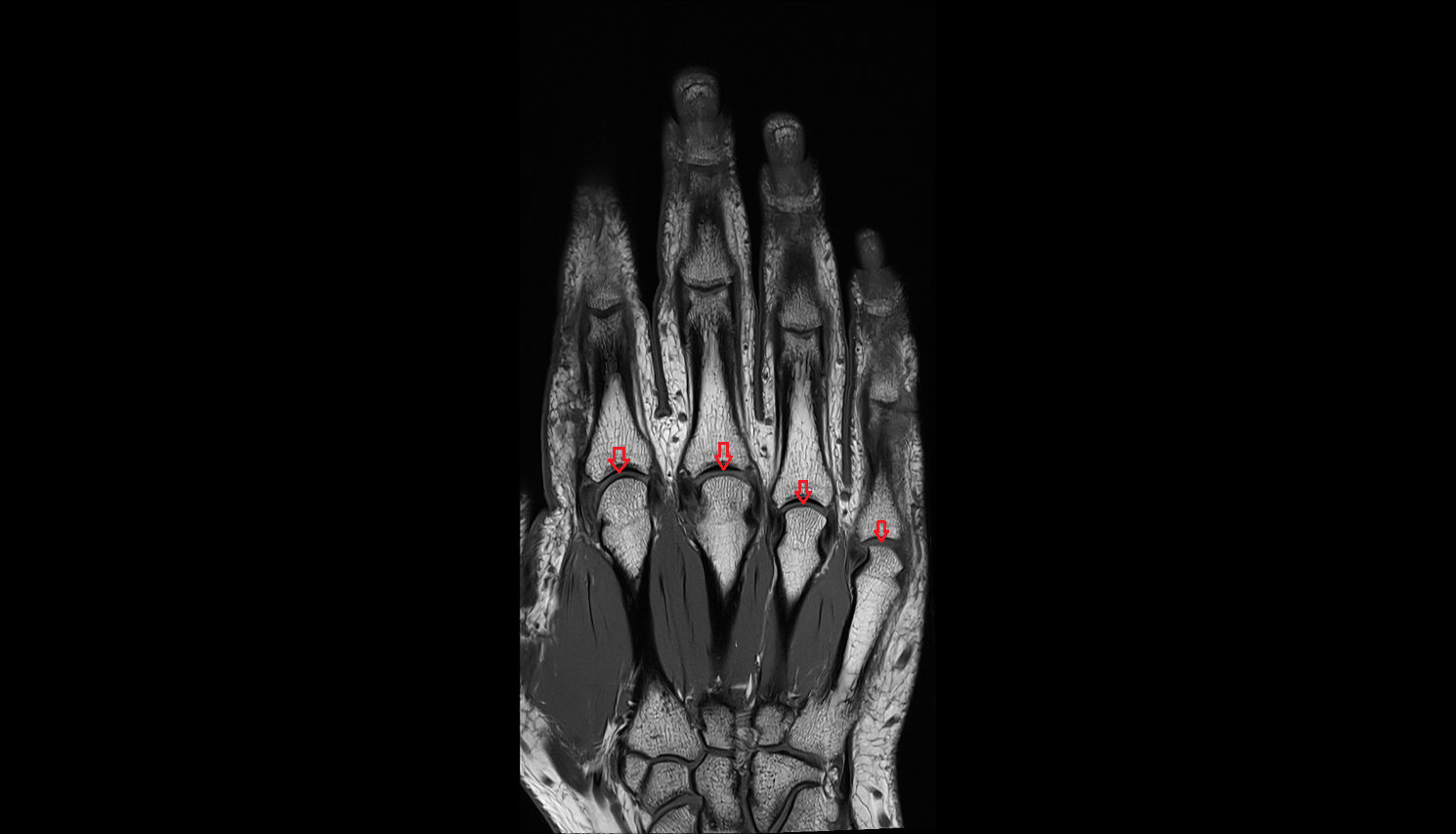 Metacarpophalangeal joints coronal cross sectional anatomy 3T MRI AI enhanced radiology image-img-00000-00000