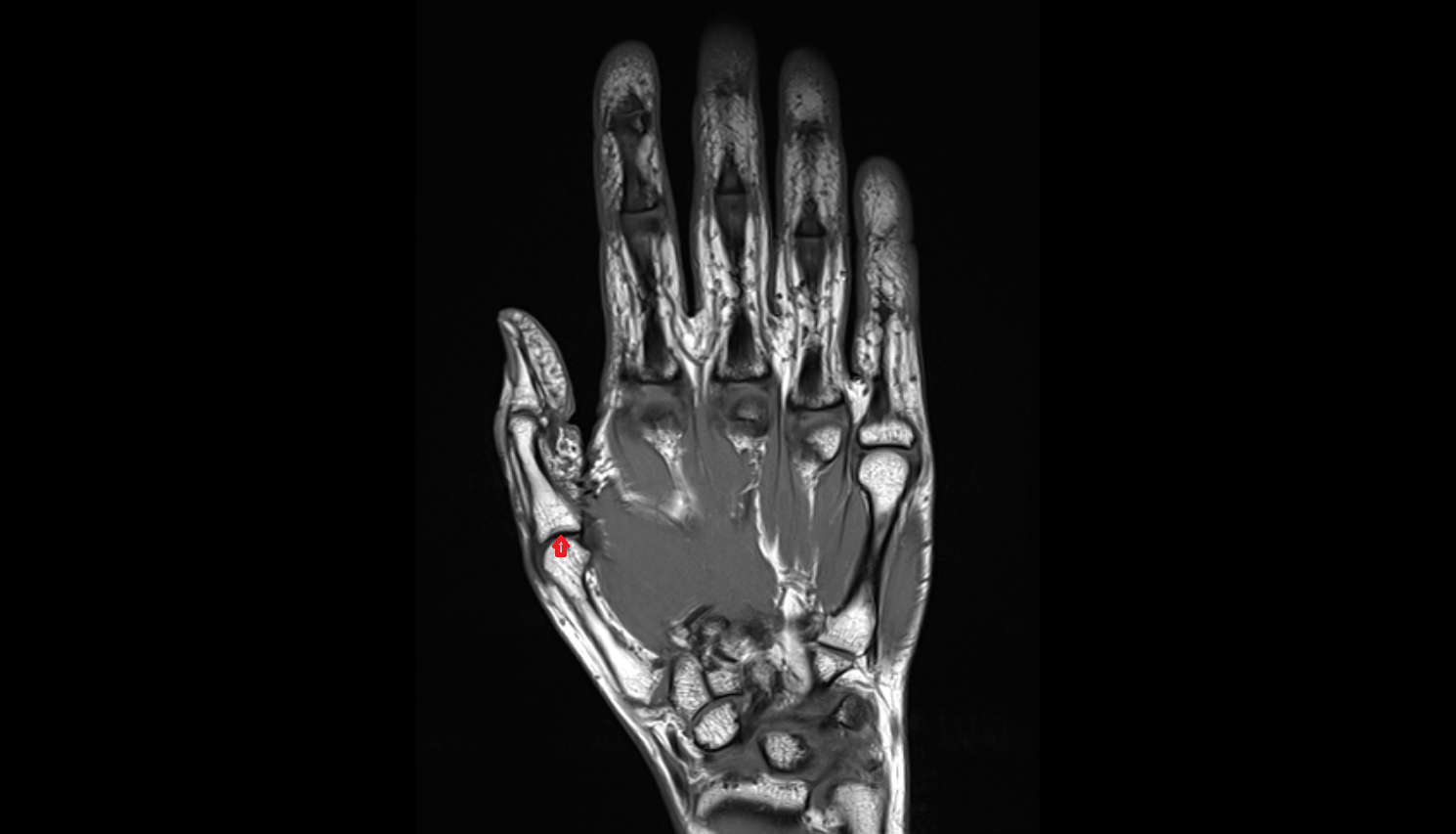 Metacarpophalangeal joints coronal cross sectional anatomy 3T MRI AI enhanced radiology image-img-00000-00000_00001