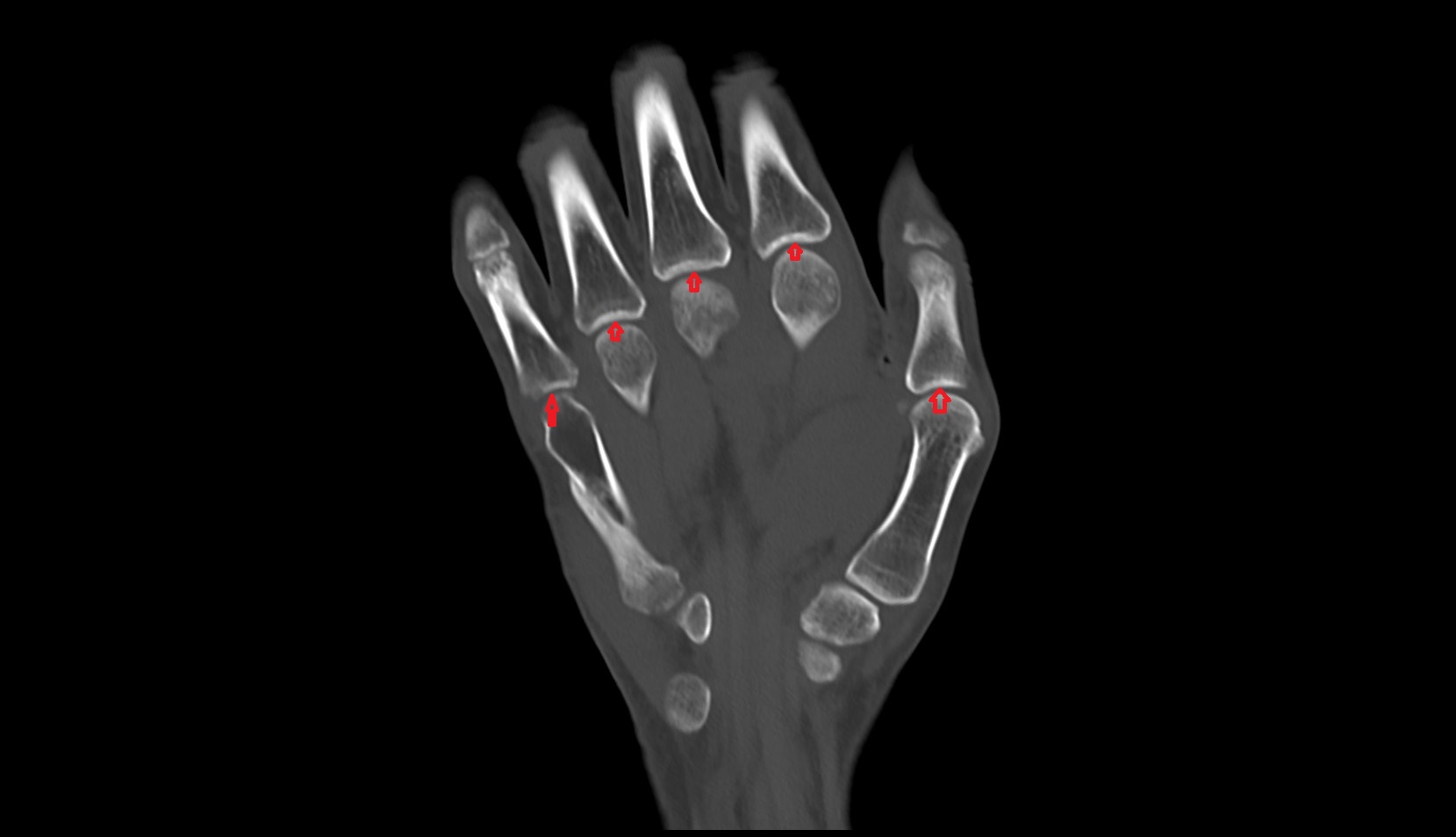 Metacarpophalangeal joints ct coronal image