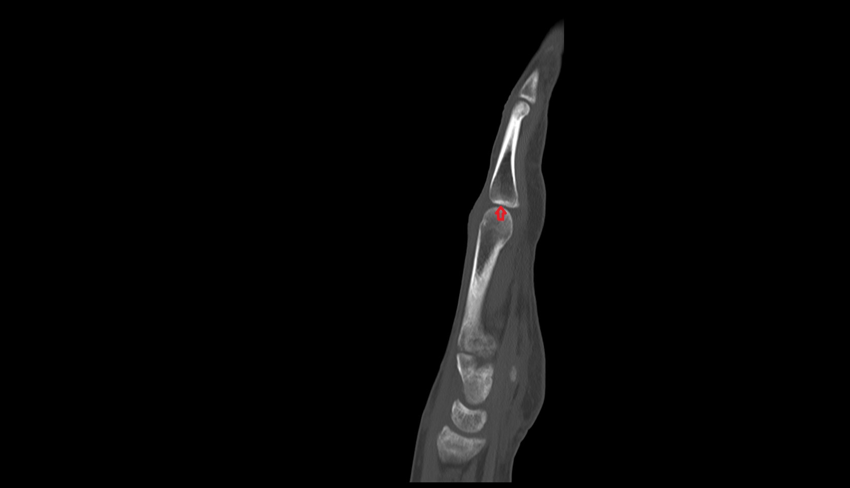 Metacarpophalangeal joints ct sagittal image