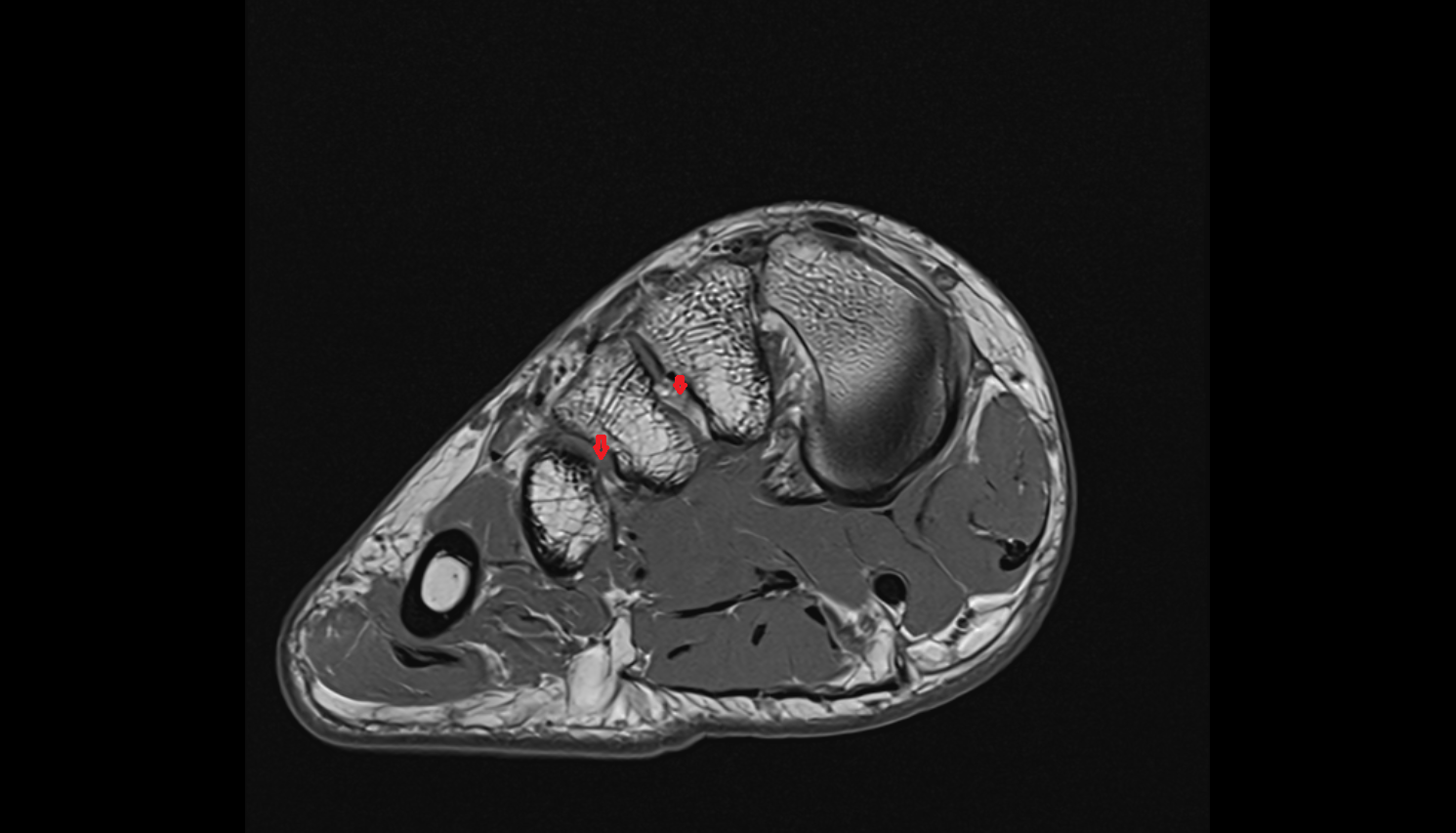 Metatarsal interosseous ligaments coronal cross sectional anatomy 3T MRI AI enhanced radiology image-img-00000-00000
