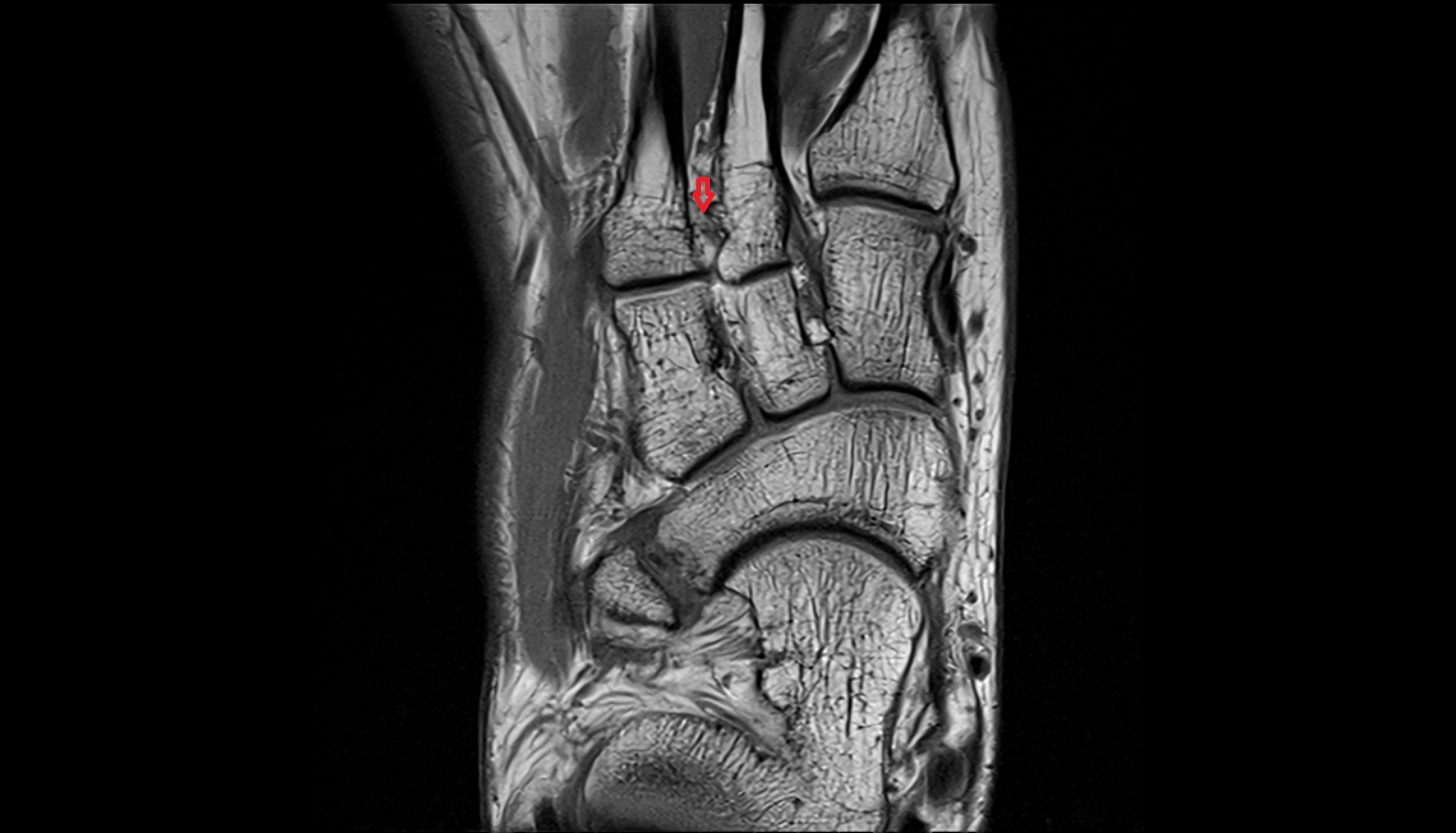 Metatarsal interosseous ligaments coronal cross sectional anatomy 3T MRI AI enhanced radiology image-img-00000-00000_00001