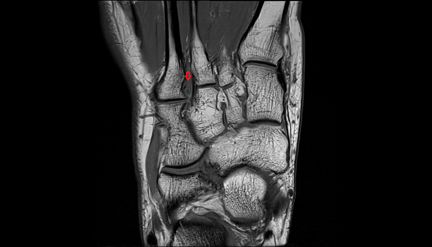 Metatarsal interosseous ligaments coronal cross sectional anatomy 3T MRI AI enhanced radiology image-img-00000-00000_00002
