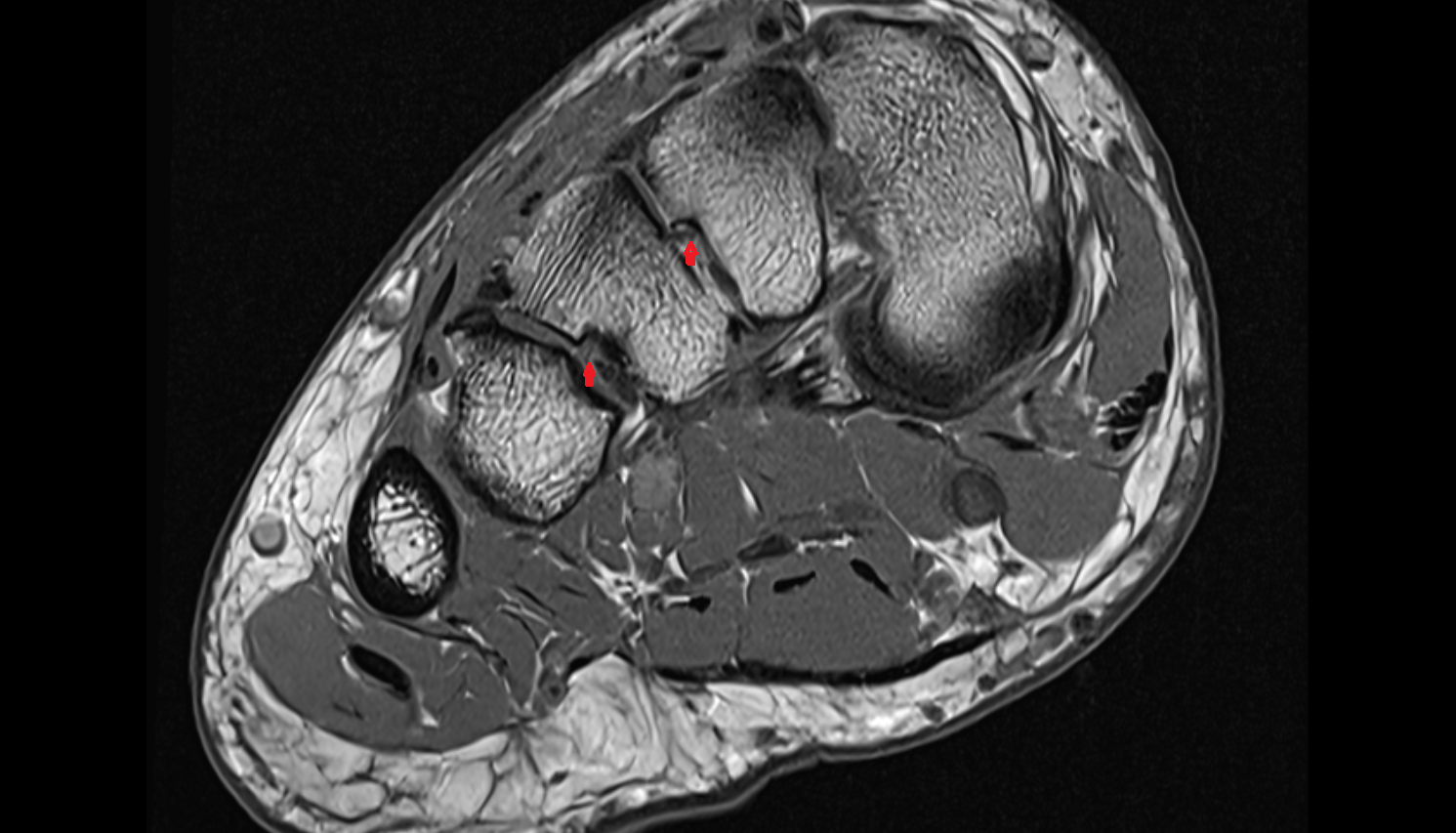 Metatarsal interosseous ligaments coronal cross sectional anatomy 3T MRI AI enhanced radiology image-img-00000-00000_00003