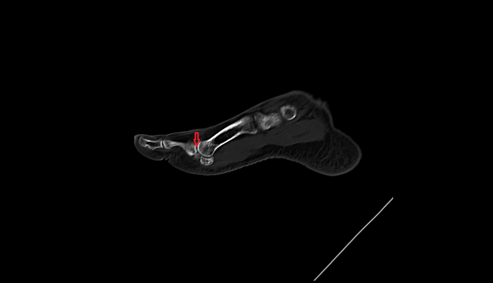 Metatarsophalangeal joint of great toe 2