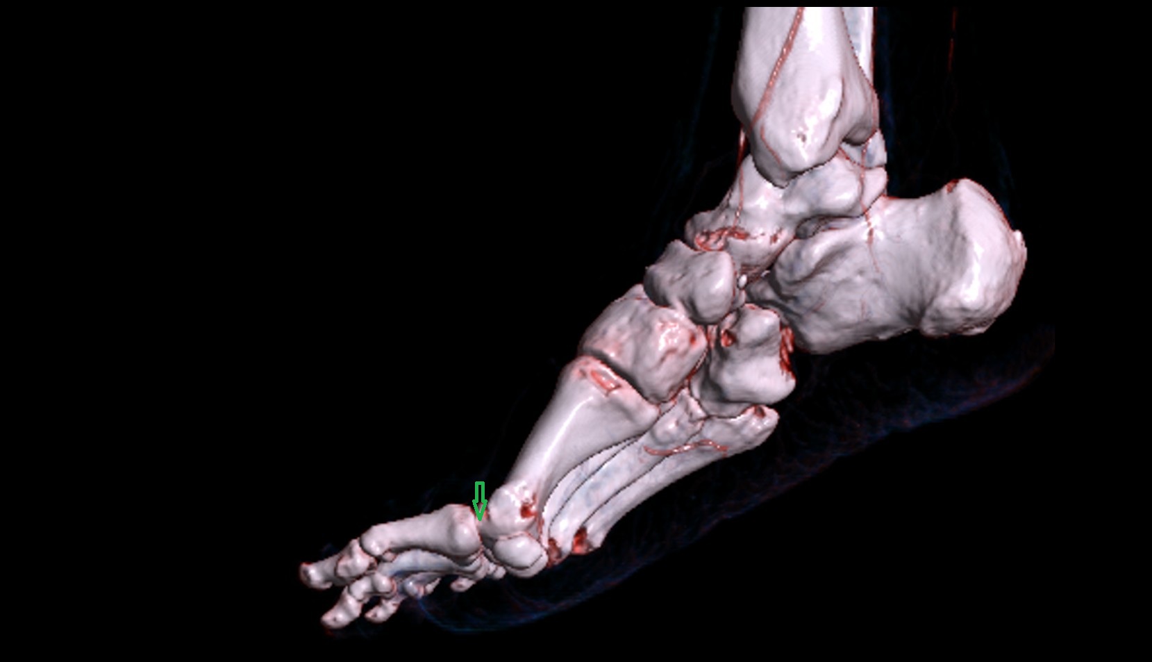 Metatarsophalangeal joint of great toe 3D