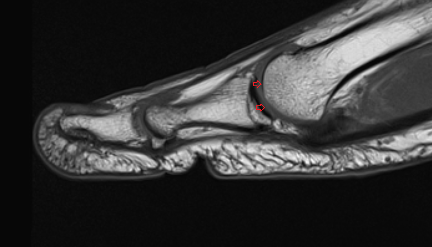 Metatarsophalangeal joint of great toe mri  anatomy labelled image-img-00000-00000