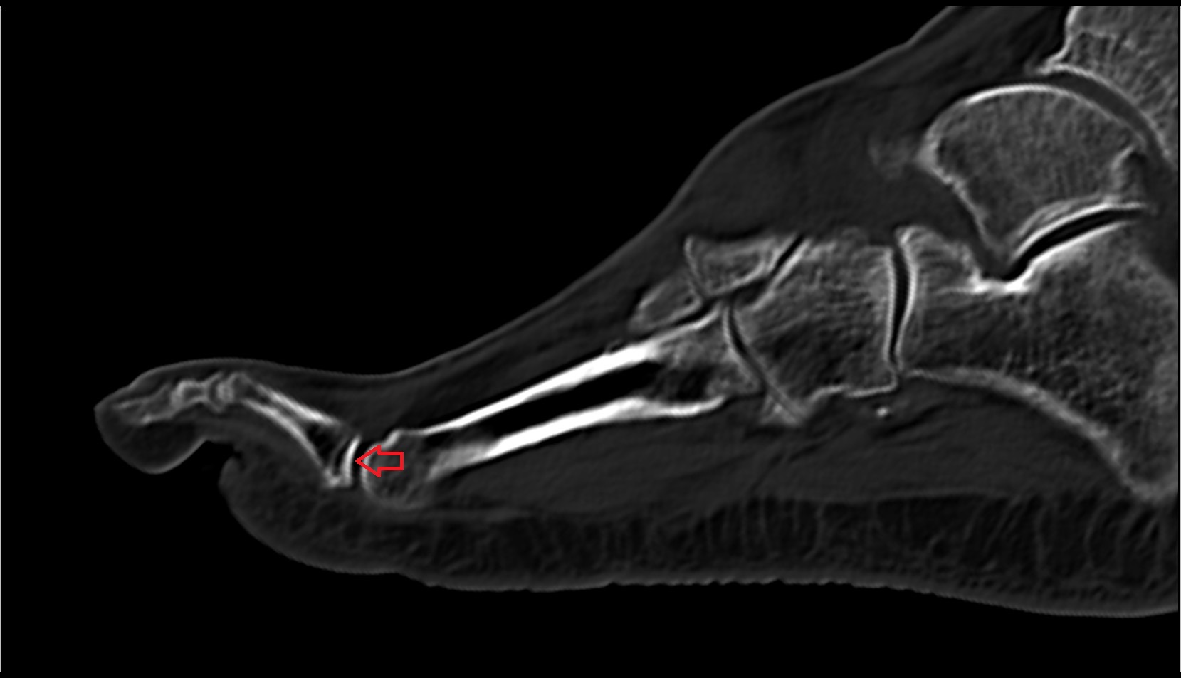 Metatarsophalangeal joints CT SAG IMAGE