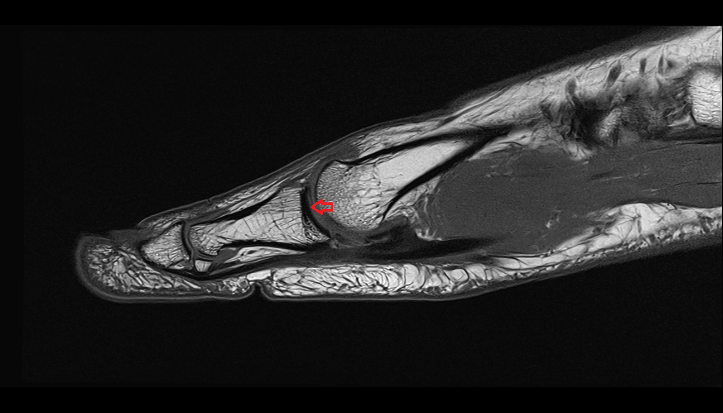 Metatarsophalangeal joints  of foot SAG cross sectional anatomy 3T MRI AI enhanced radiology image-img-00000-00000