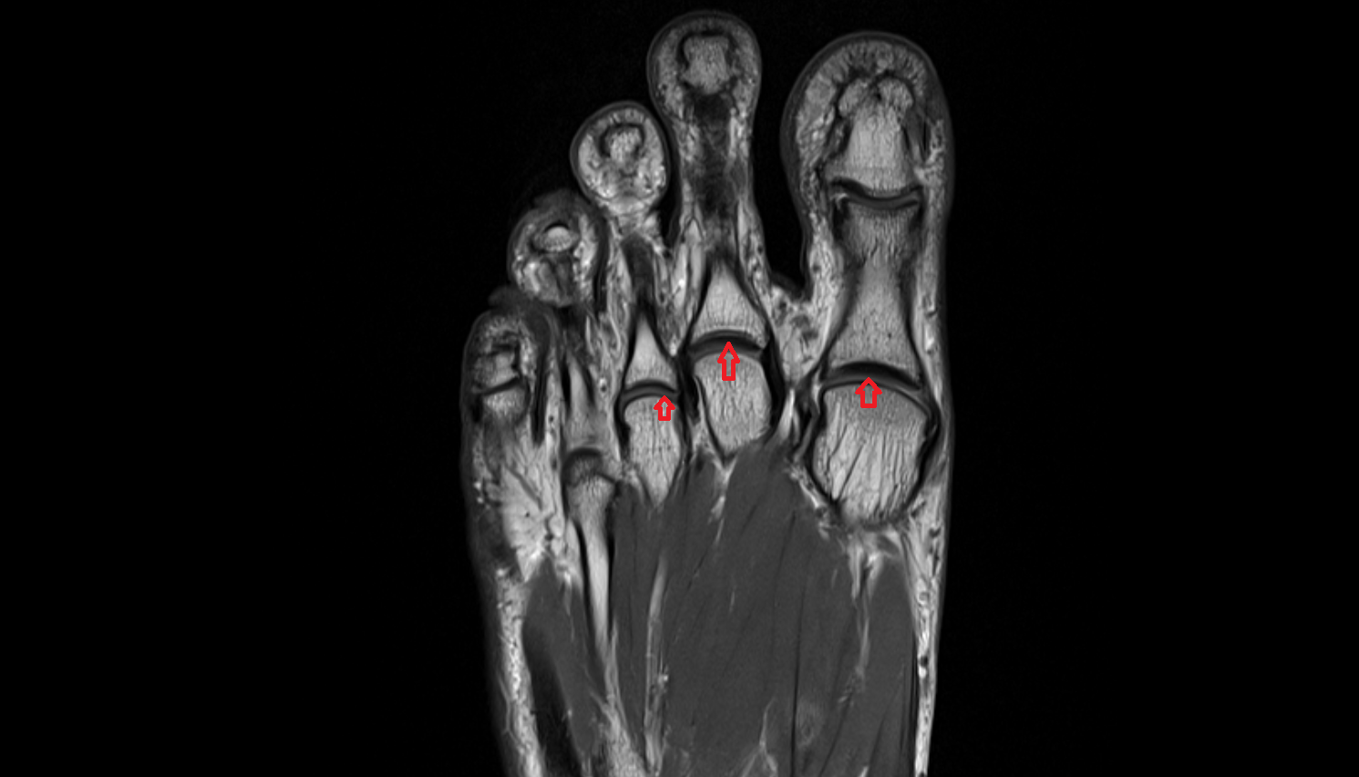 Metatarsophalangeal joints  of foot coronal cross sectional anatomy 3T MRI AI enhanced radiology image-img-00000-00000_00001