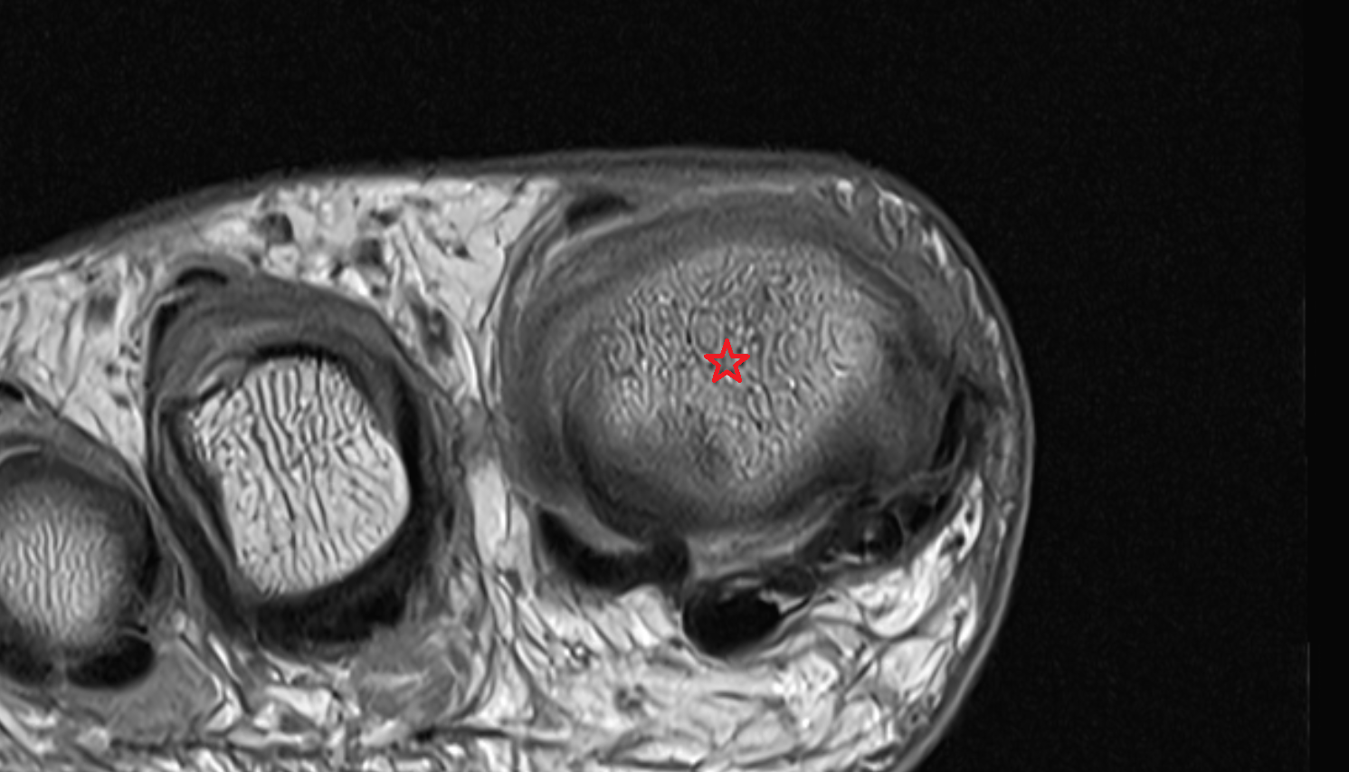 Metatarsophalangeal joints  of foot coronal cross sectional anatomy 3T MRI AI enhanced radiology image-img-00000-00000_00002