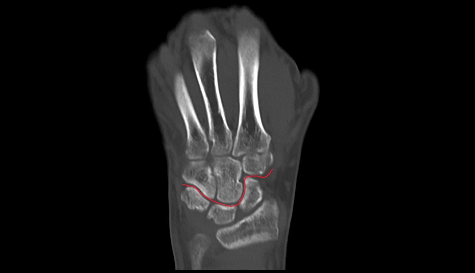Midcarpal joint CT coronal image
