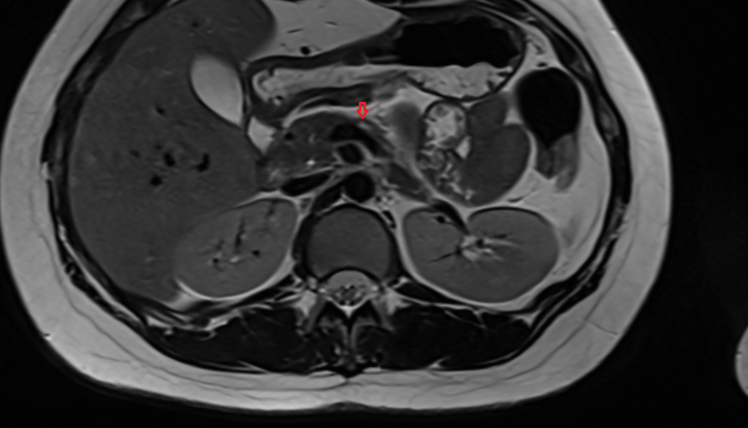 Middle Colic Vein  MRI coronal  image-img-00000-00000