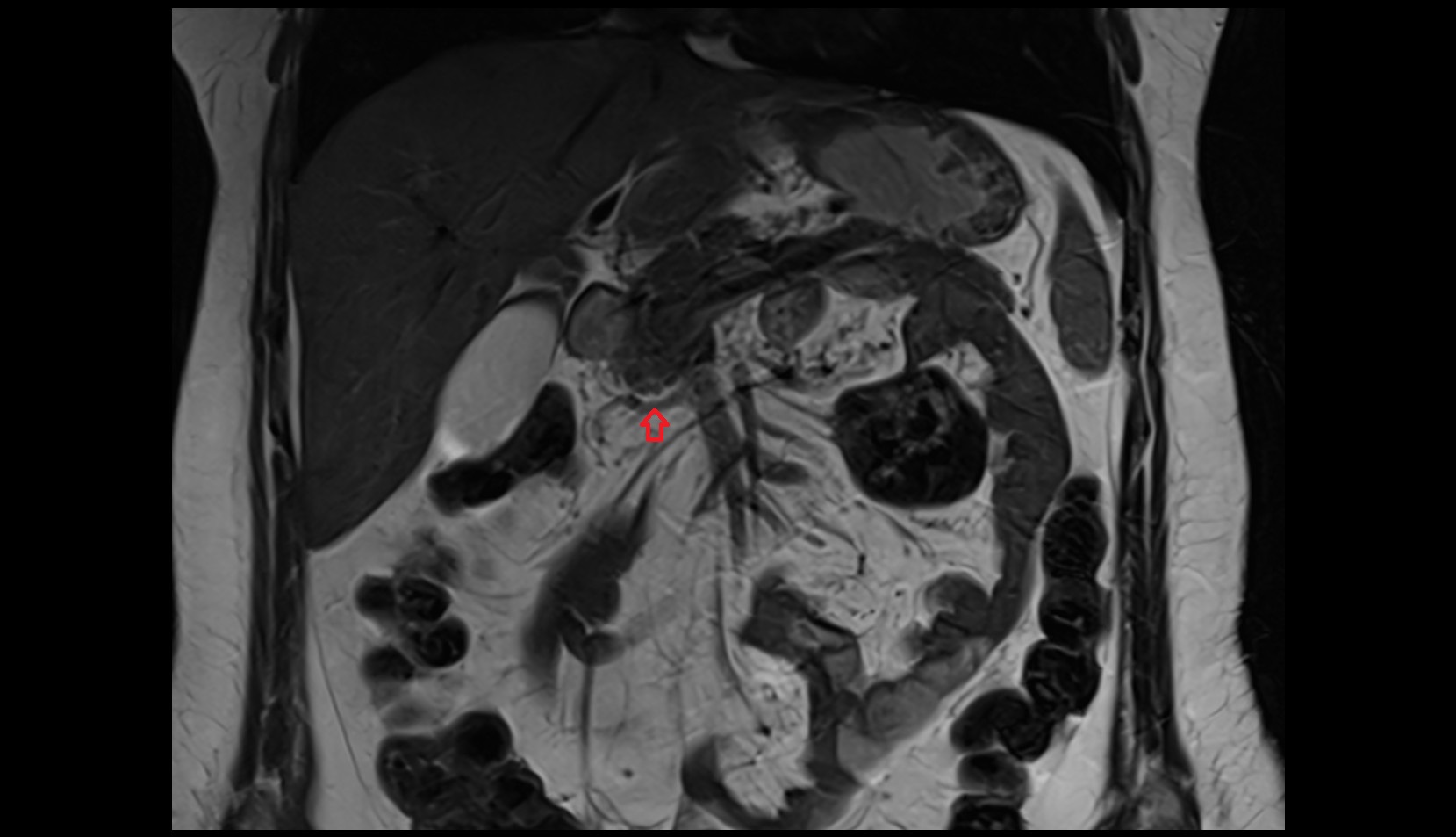 Middle Colic Vein mri coronal