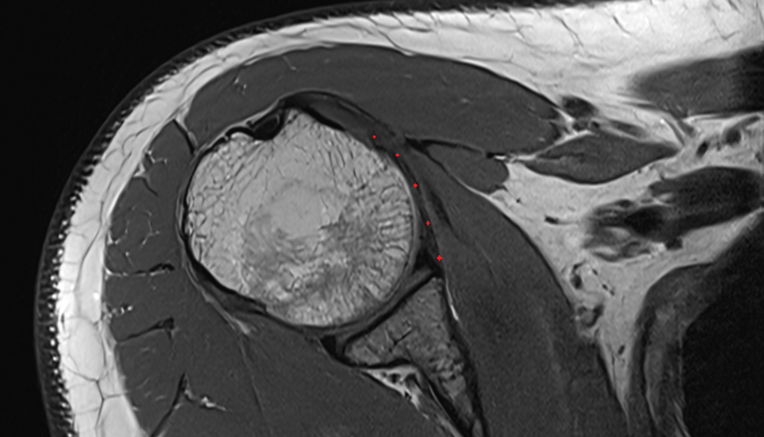 Middle Glenohumeral Ligament (MGHL) axial cross sectional anatomy 3T MRI AI enhanced radiology image-img-00000-00000