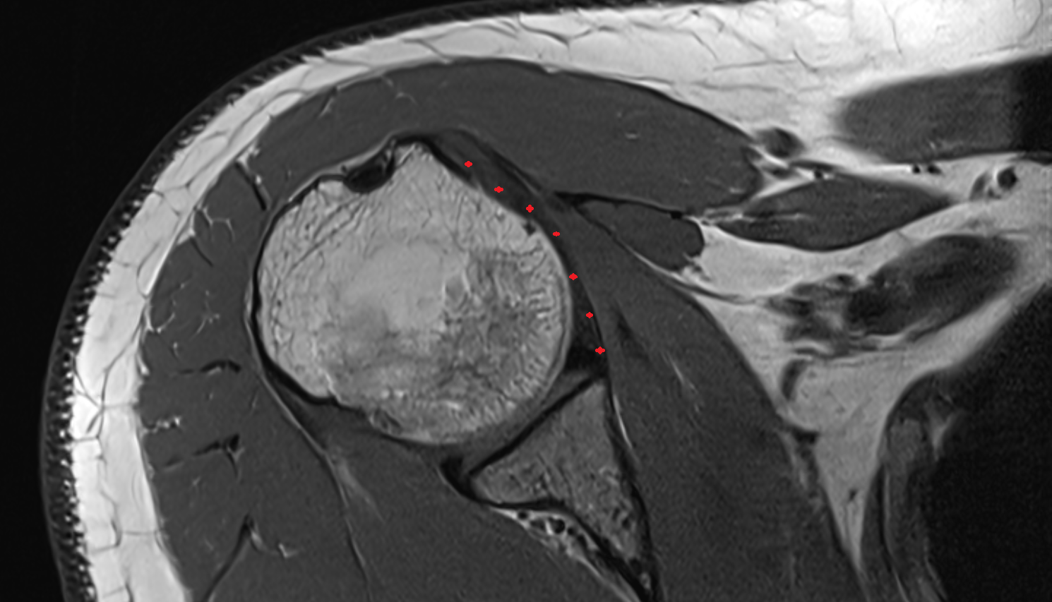 Middle Glenohumeral Ligament (MGHL) axial cross sectional anatomy 3T MRI AI enhanced radiology image-img-00000-00000_00001