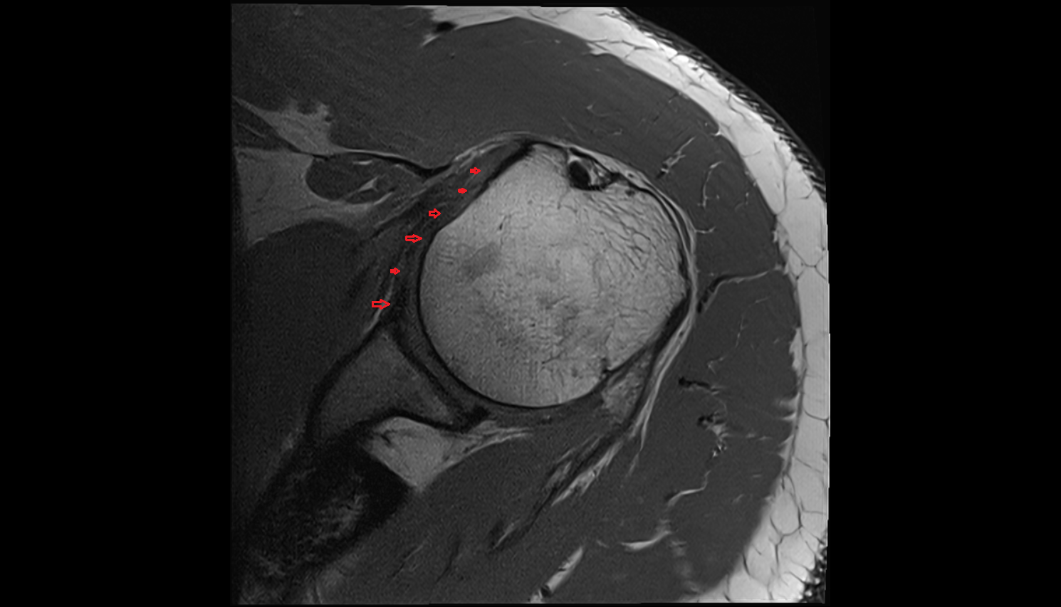 Middle Glenohumeral Ligament (MGHL) axial cross sectional anatomy 3T MRI AI enhanced radiology image-img-00000-00000_00002