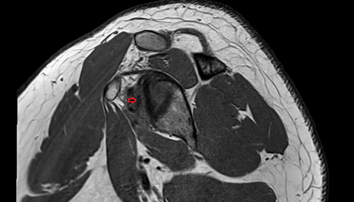 Middle Glenohumeral Ligament sagittal cross sectional anatomy 3T MRI AI enhanced radiology image-img-00000-00000