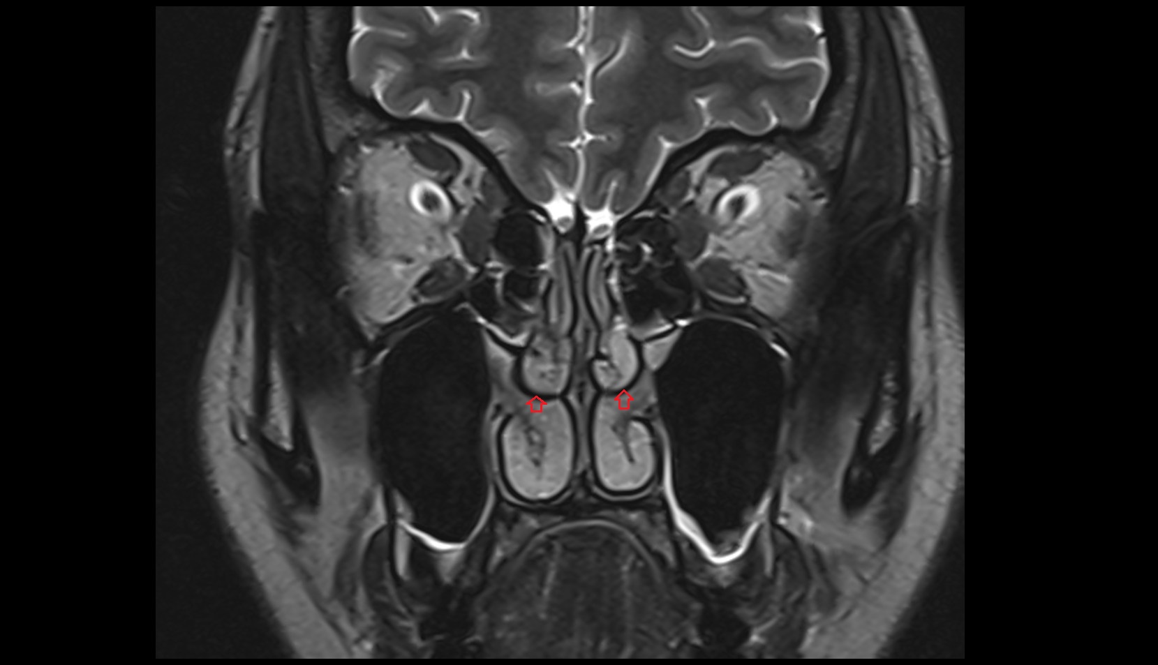 Middle Nasal Meatus mri coronal image