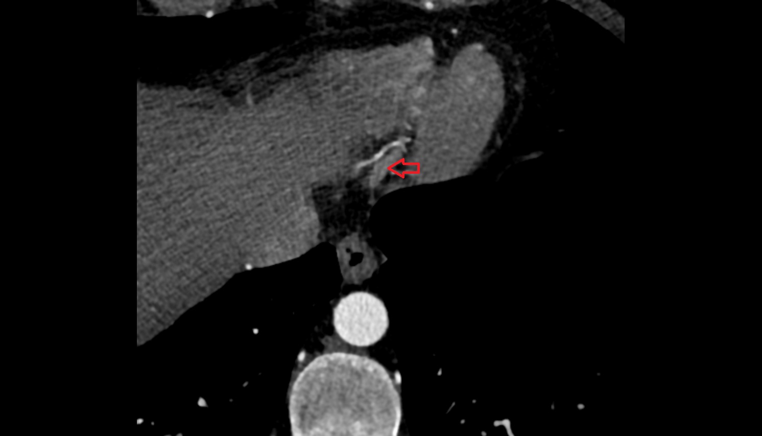 Middle cardiac vein  CT  axial image -img-00000-00000
