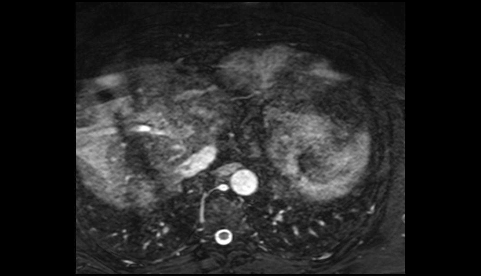 Middle cardiac vein mri image