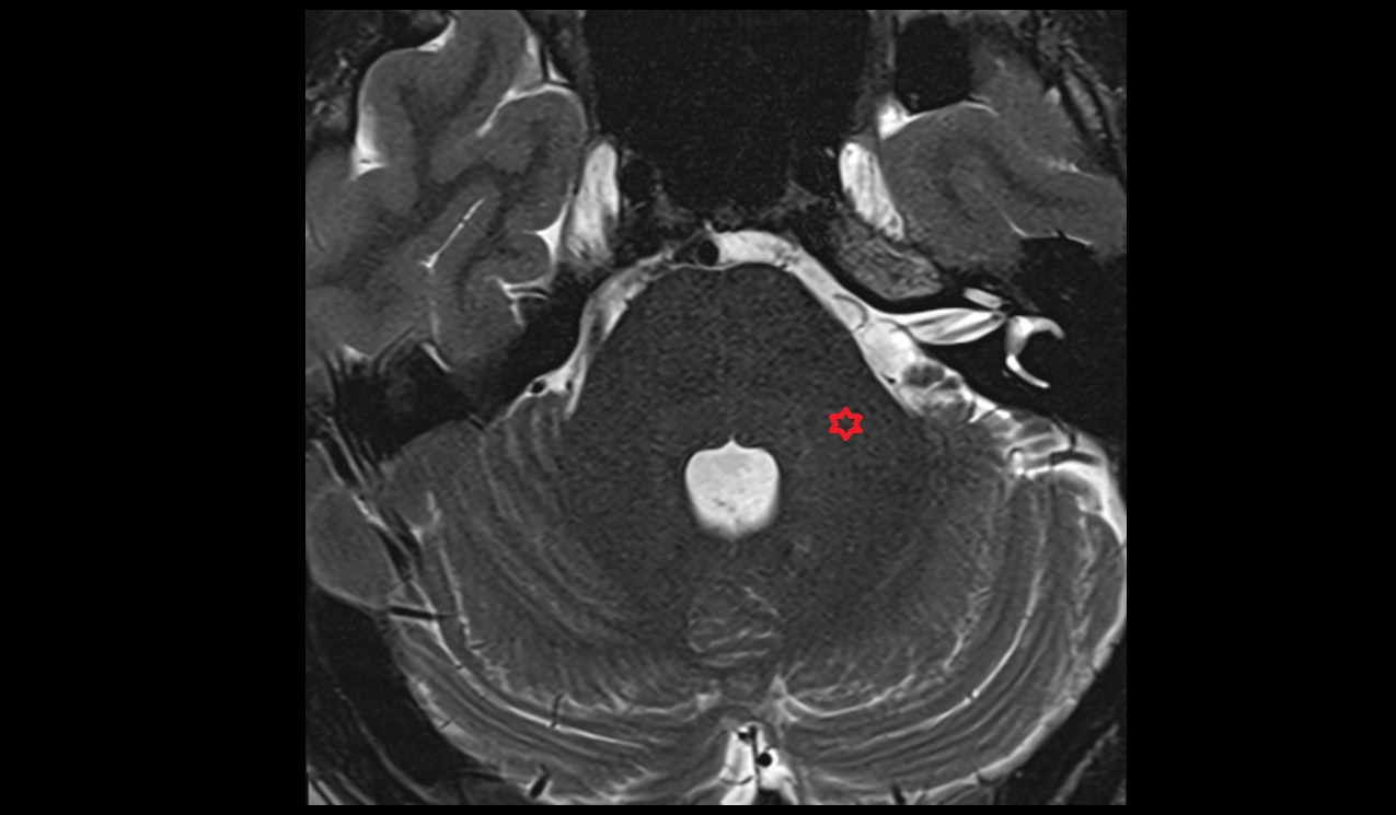 Middle cerebellar peduncle MRI 3T axial image