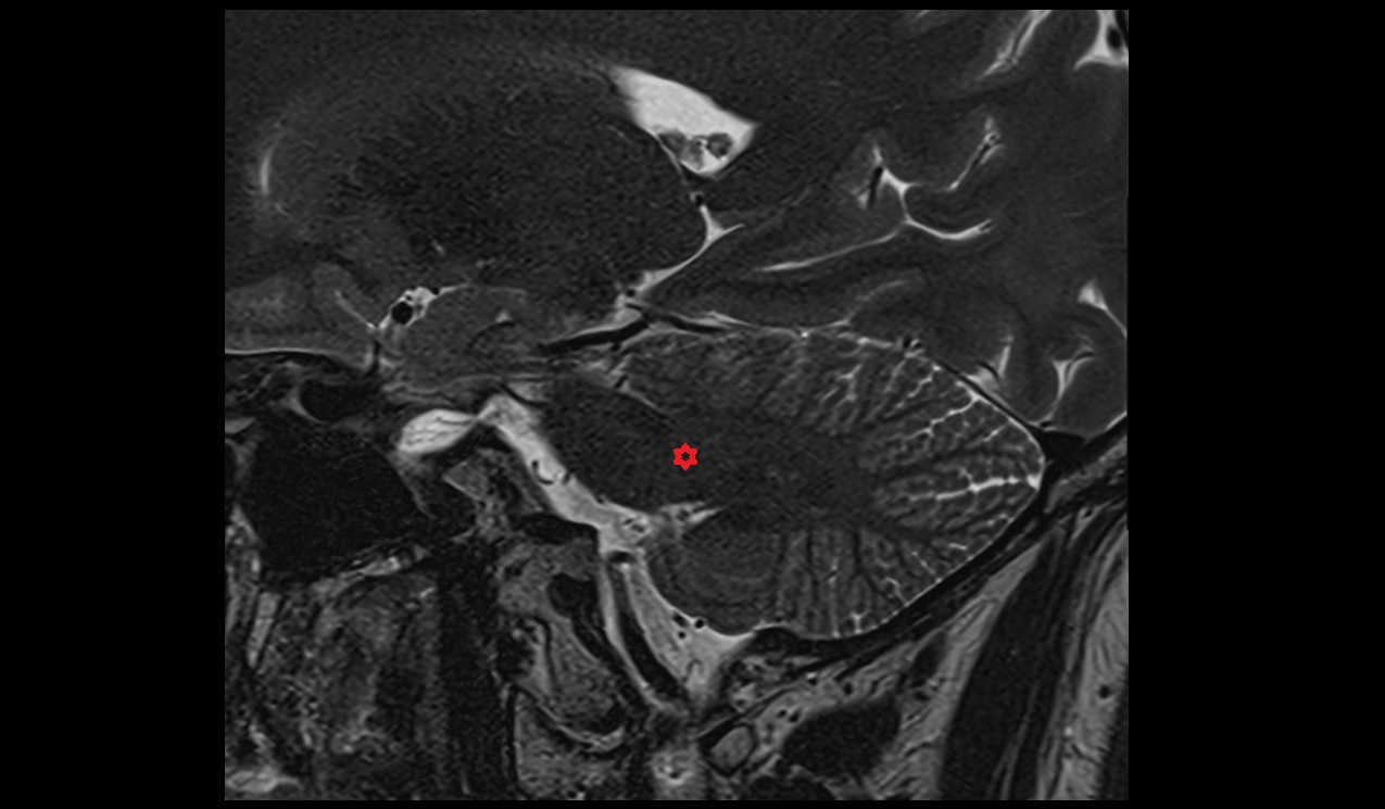 Middle cerebellar peduncle MRI 3T sagittal image