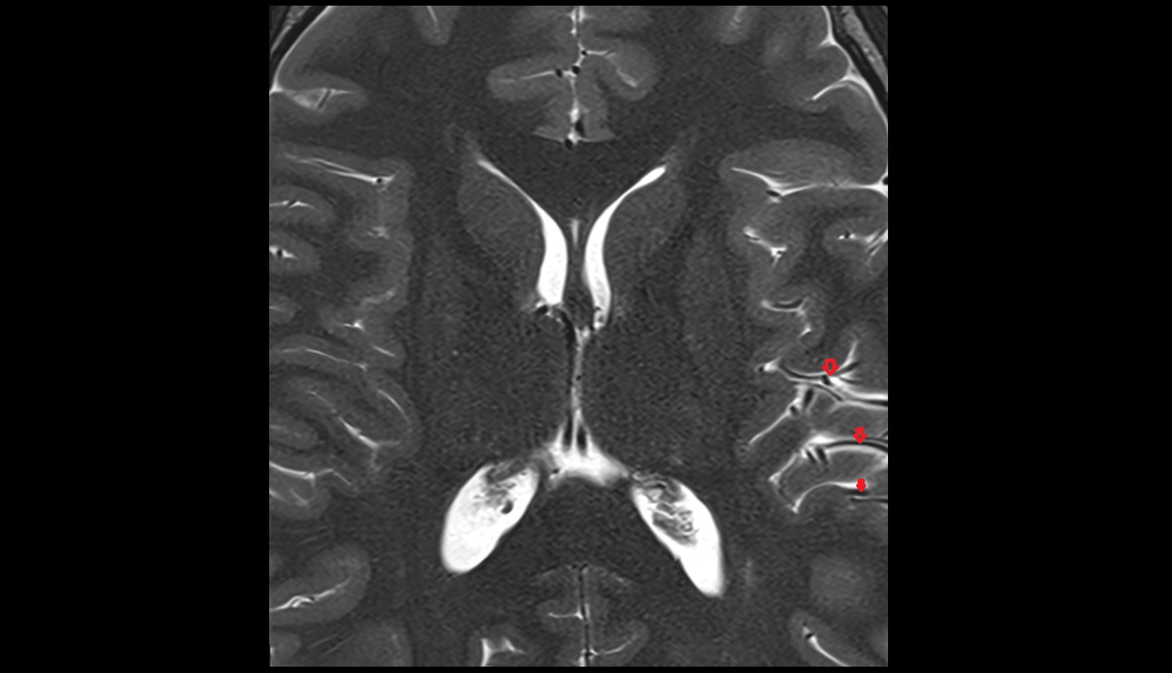 Middle cerebral artery cortical segment (M4)