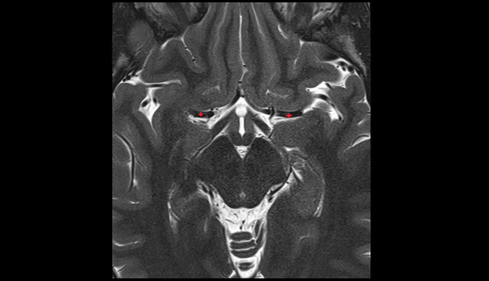 Middle cerebral artery horizontal segment (M1)
