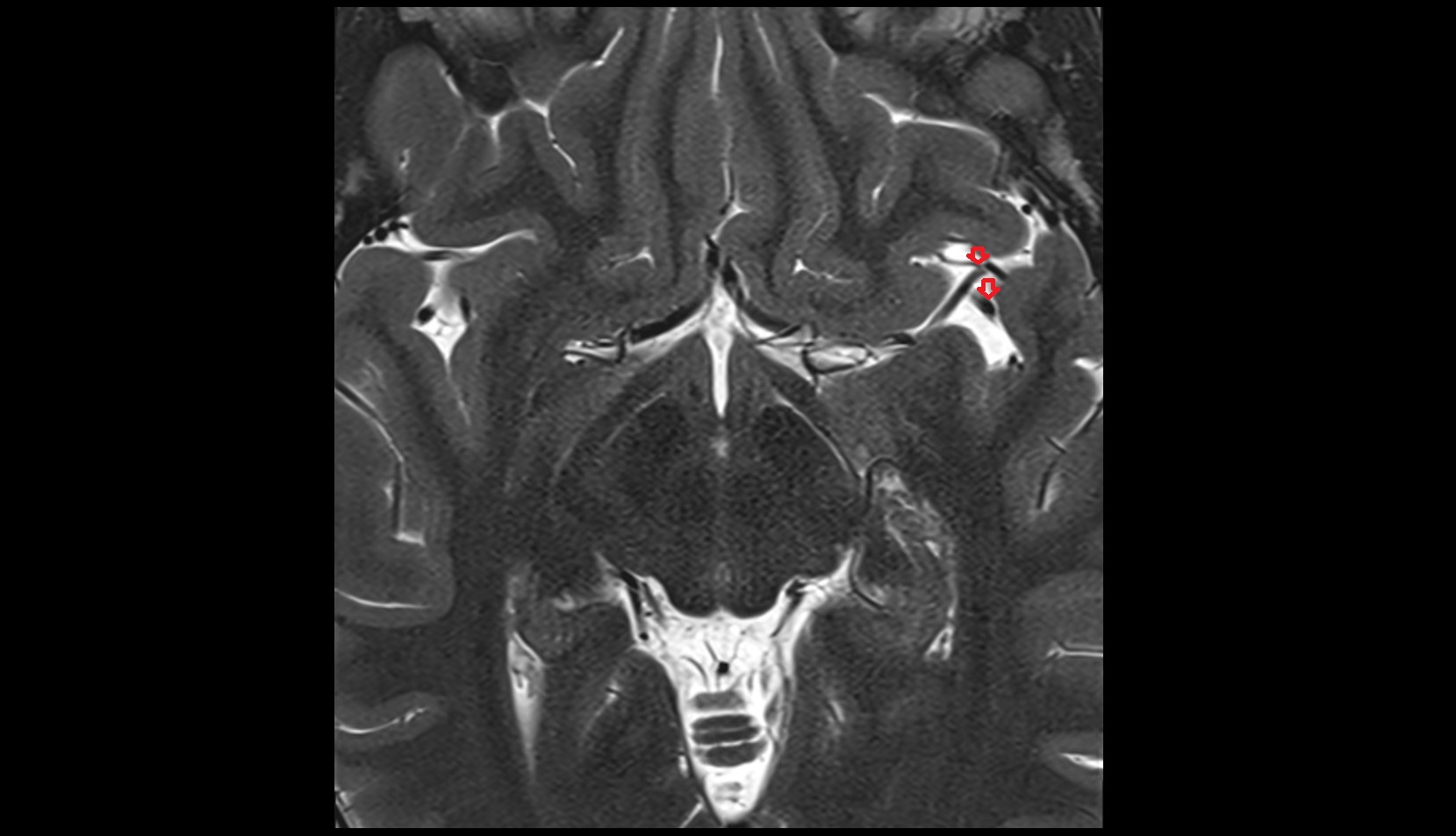 Middle cerebral artery insular segment (M2)