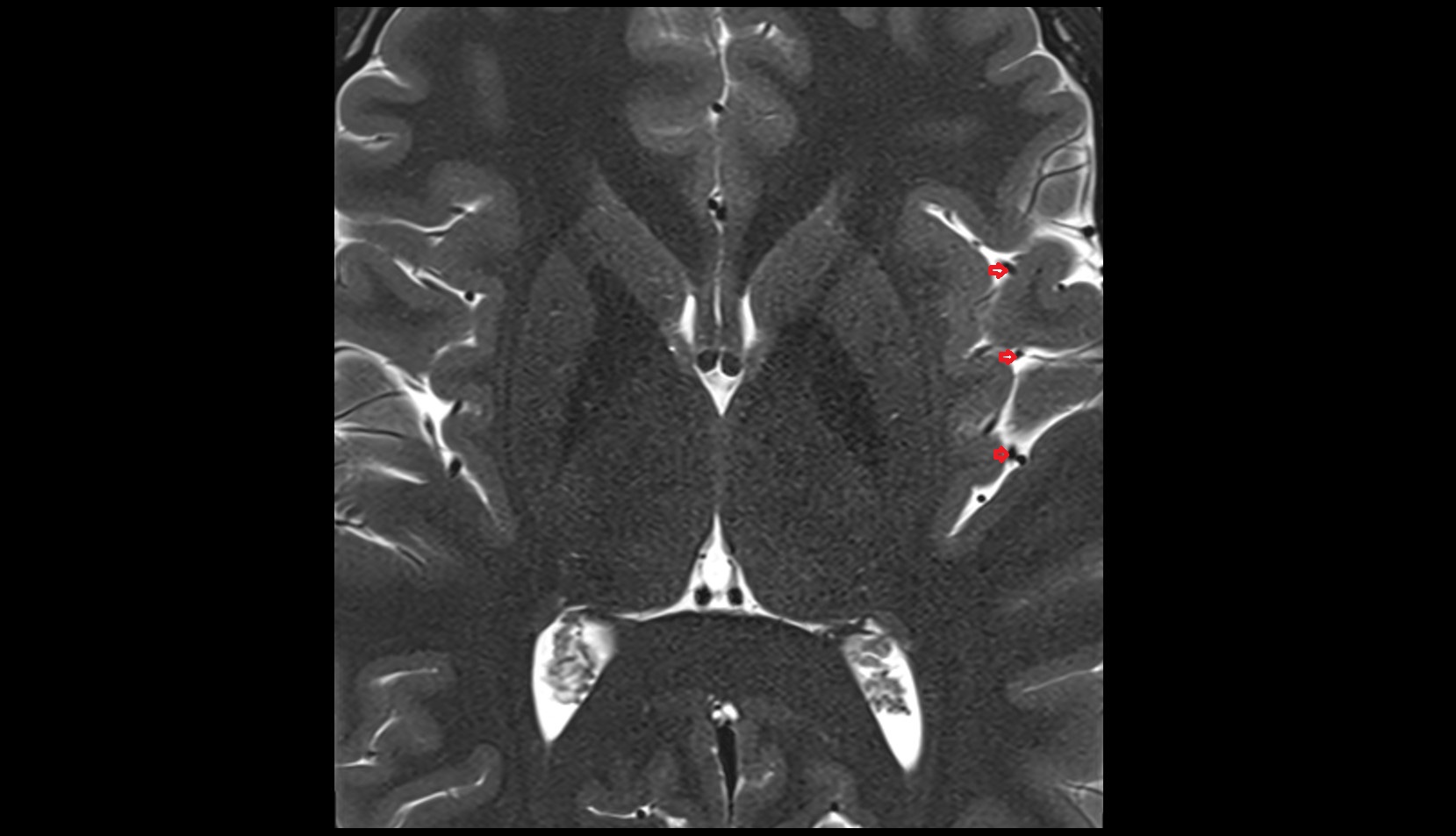 Middle cerebral artery opercular segment (M3)