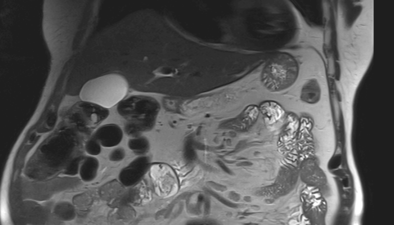 Middle colic artery MRI coronal anatomy  image -img-00000-00000