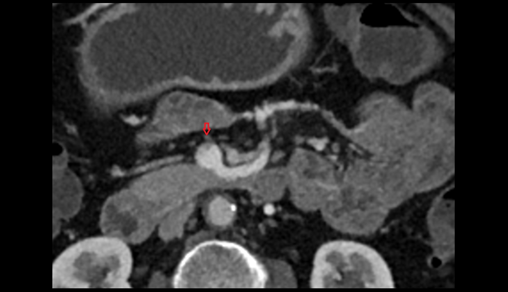 Middle colic artery ct axial