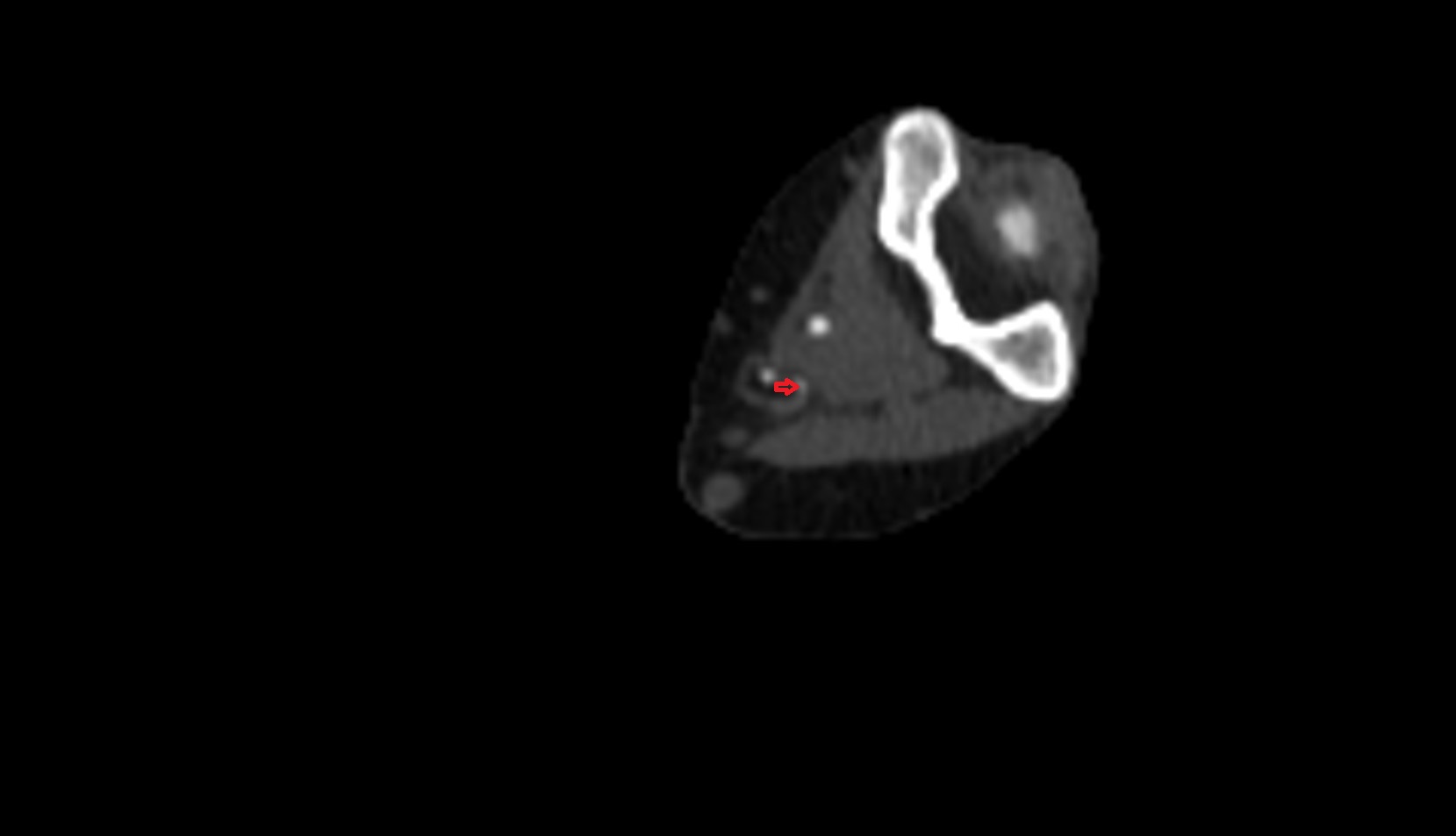 Middle collateral artery CT AXIAL image