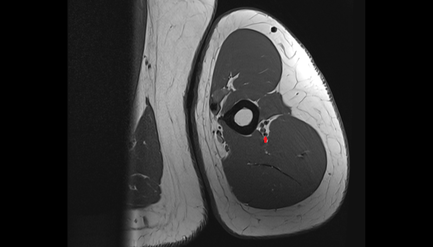 Middle collateral artery axial cross sectional anatomy 3T MRI AI enhanced radiology image -img-00000-00000