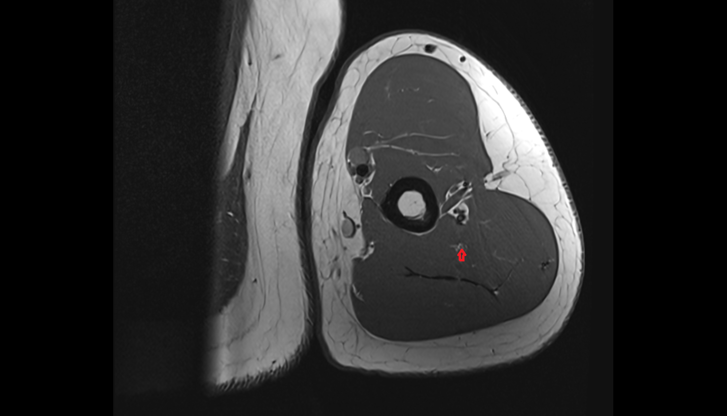 Middle collateral artery axial cross sectional anatomy 3T MRI AI enhanced radiology image -img-00000-00000_00001