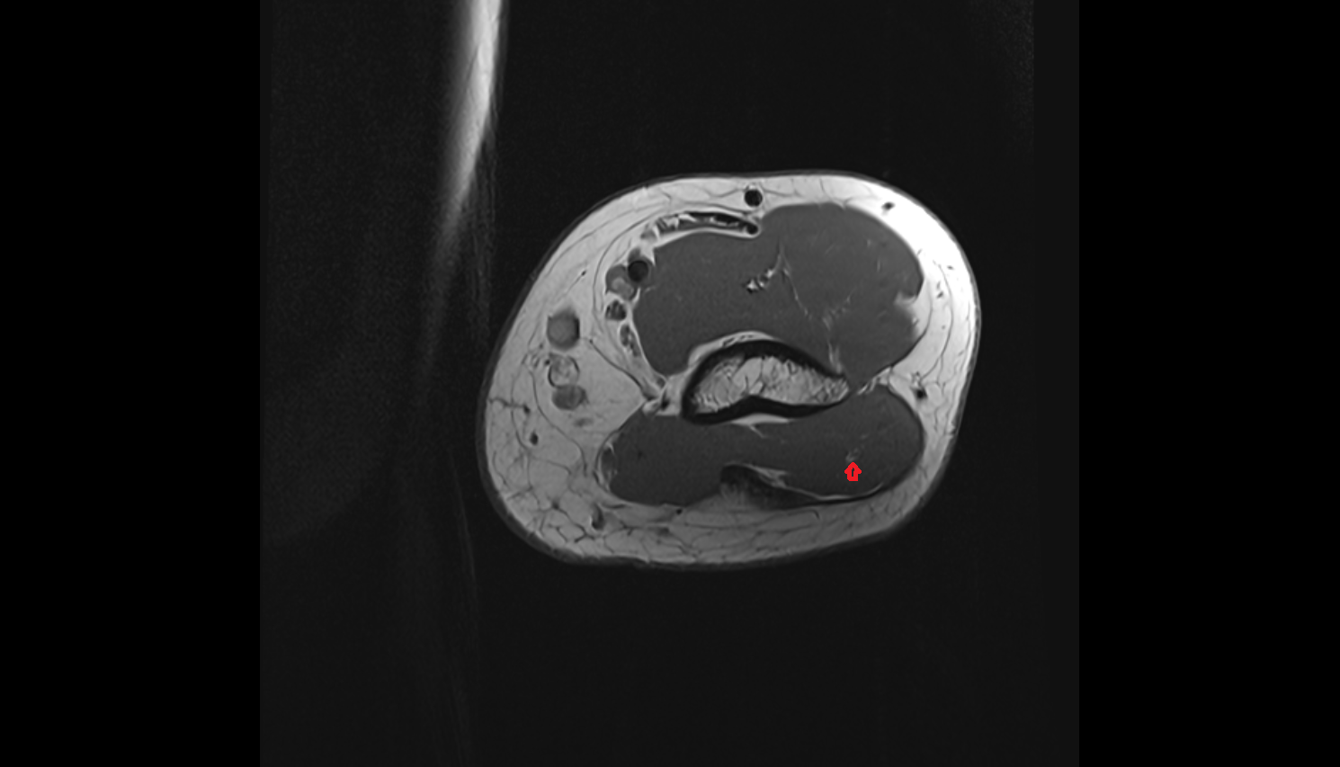 Middle collateral artery axial cross sectional anatomy 3T MRI AI enhanced radiology image -img-00000-00000_00002