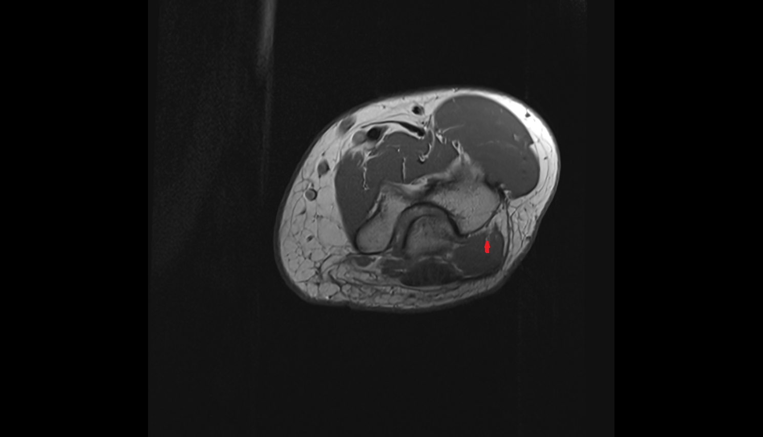 Middle collateral artery axial cross sectional anatomy 3T MRI AI enhanced radiology image -img-00000-00000_00003