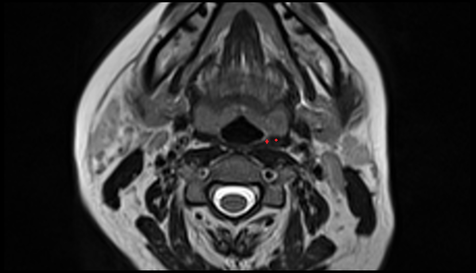 Middle constrictor muscle of pharynx mri axial image