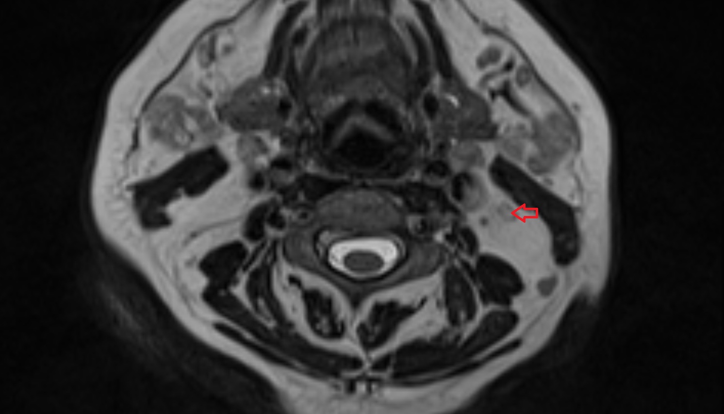 Middle deep cervical lymph nodes  mri axial  image -img-00000-00000