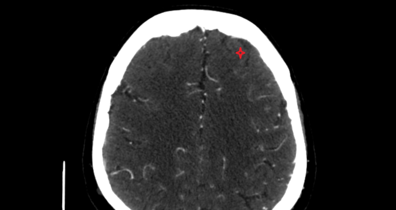 Middle frontal gyrus CT axial anatomy image -img-00001-00001