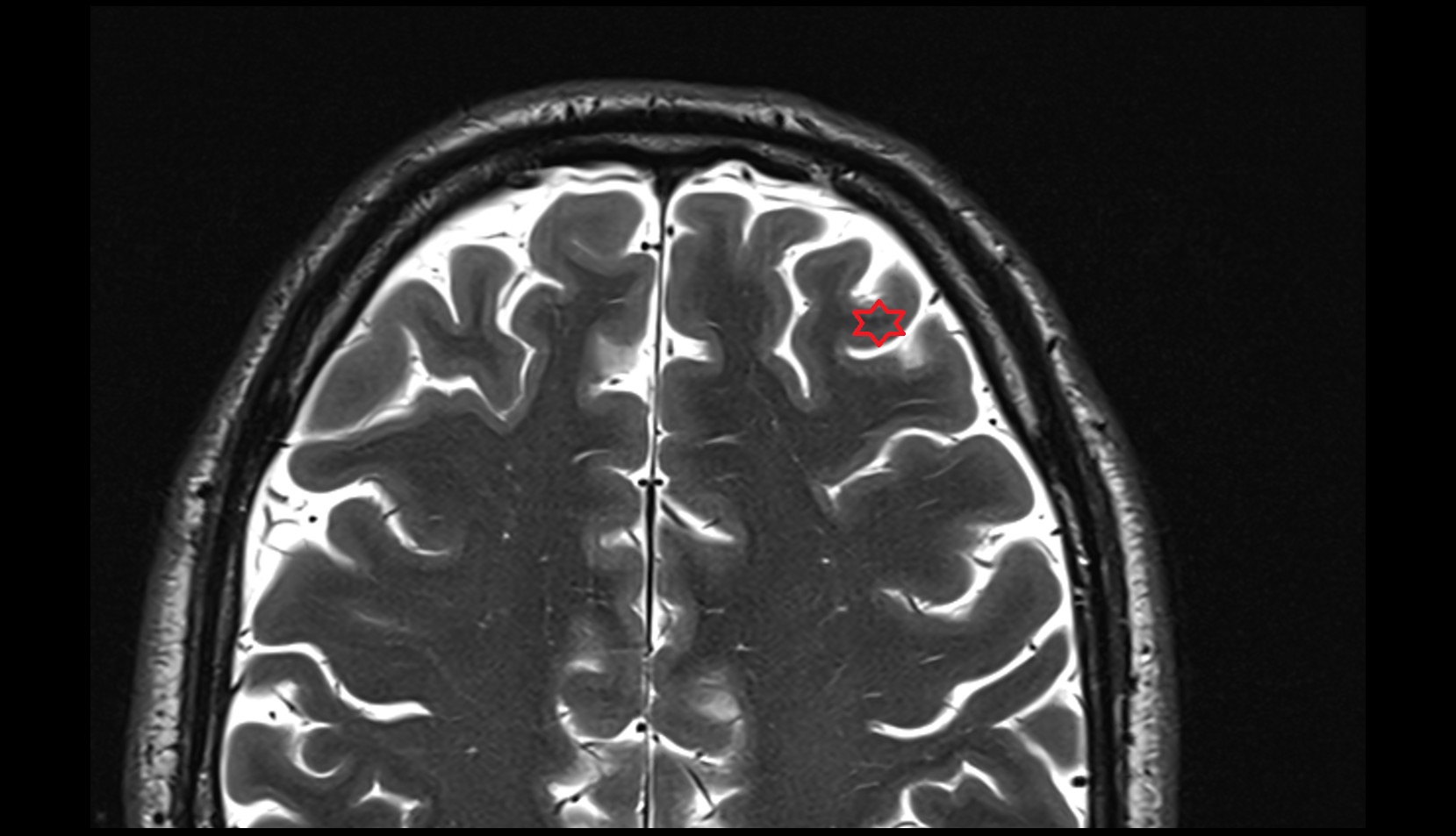 Middle frontal gyrus MRI 3T axial image