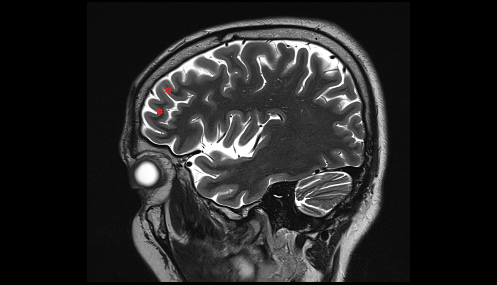 Middle frontal gyrus MRI 3T sagittal image