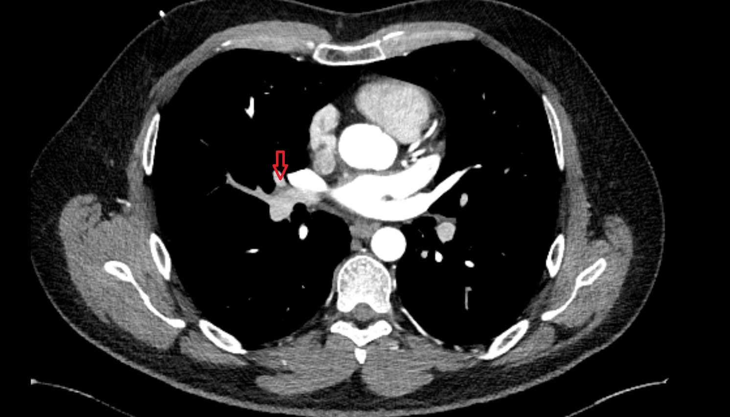 Middle lobar artery of right lung  anatomy CT axial  image -img-00000-00000